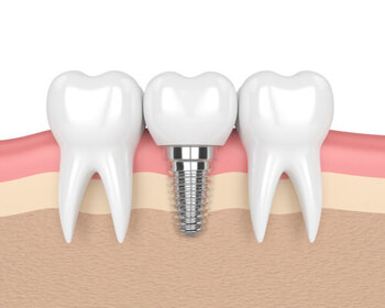 Dental Implant Procedure illustration